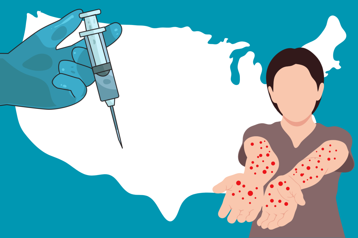 The measles are back and spreading through the United States.